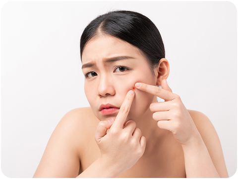 反覆長痘、痘痘冒不停