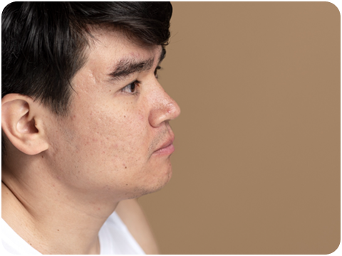 毛孔粗大、膚質粗糙不平整